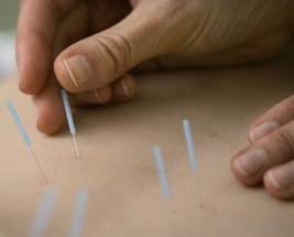 acupuncture SM